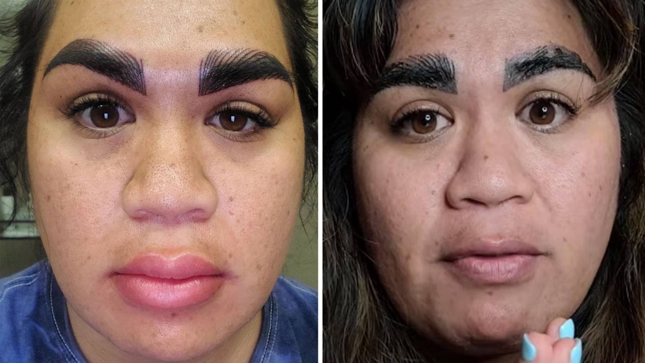 Mujer se somete a tratamiento estético y termina con el rostro arruinado