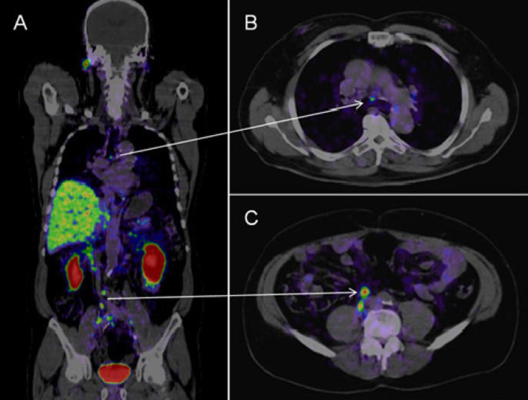 PET-CT en Quintana Roo